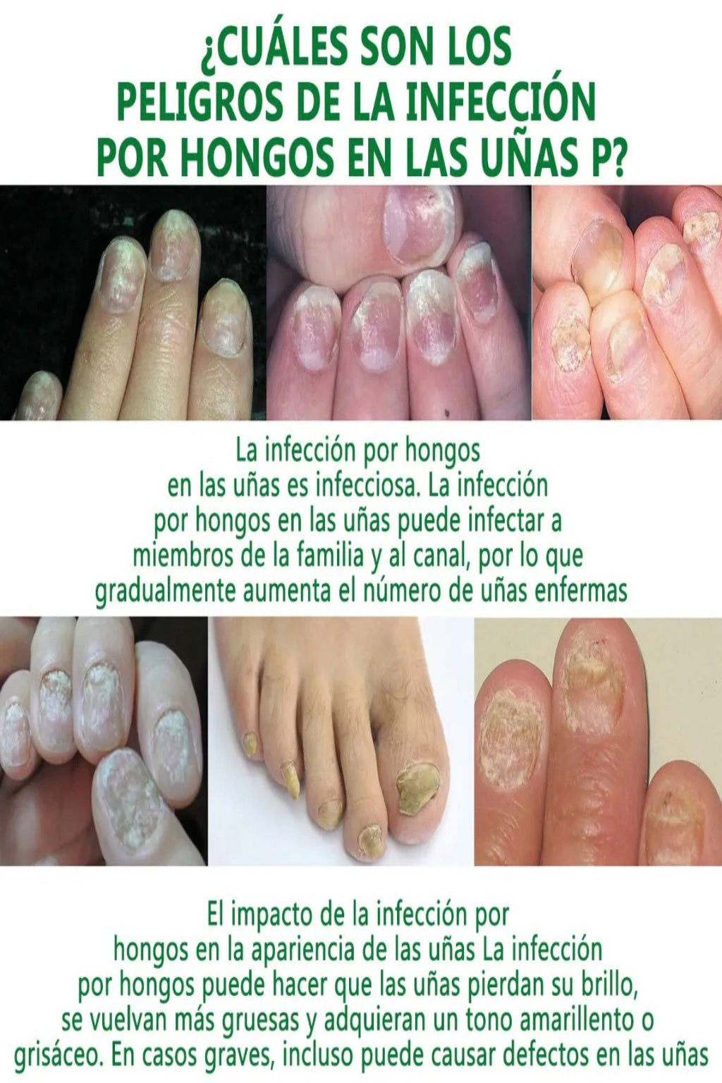 TRATAMIENTO 7 DIAS-NO MAS HONGOS !