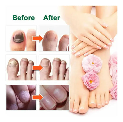 Spray para Hongos Beri